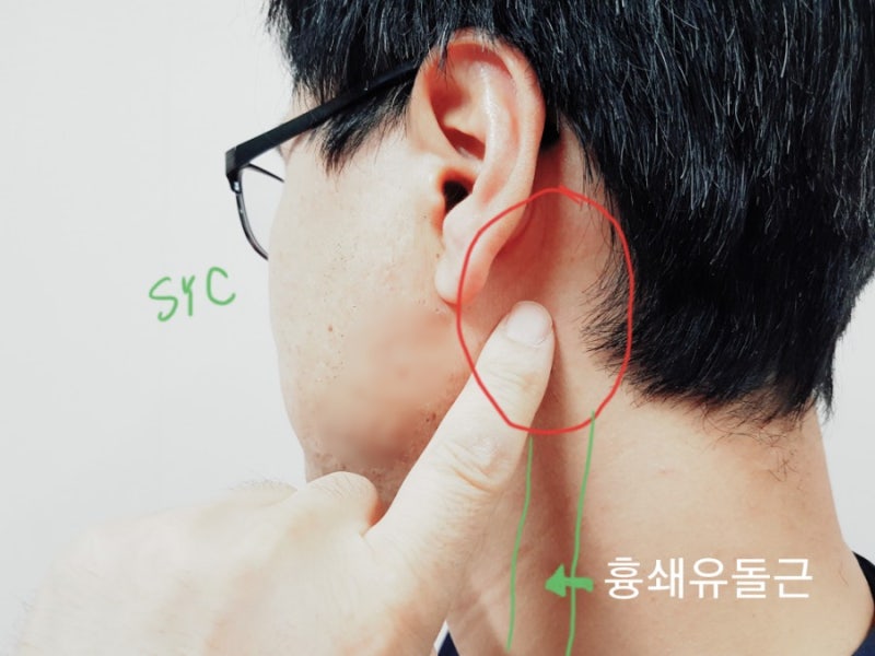 귀 뒤 후두부 목부위 만져지는 것이 있어요 - 귀 뒤 멍울 임파선염 : 네이버 블로그 귀 뒤 후두부 목부위 만져지는 것이 있어요 - 귀 뒤 멍울 임파선염 : 네이버 블로그