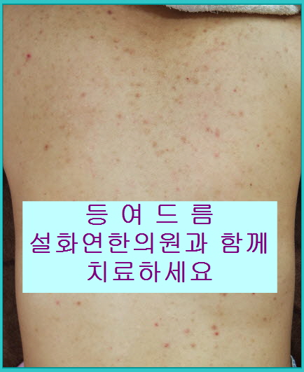 부평등여드름흉터 지금부터 깨끗해질 준비~