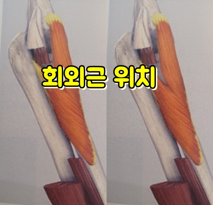  회외근(Supinator Sup) 신경포착&허혈성 통증