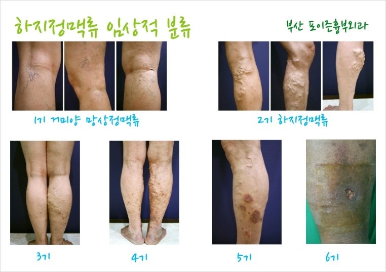 하지정맥류의 치료 방법은 중요하지 않습니다.