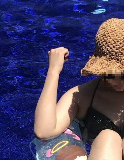  부산 부유방 수술 후기 1 : 보험 실비 청구까지 끝내고 9개월차 진입