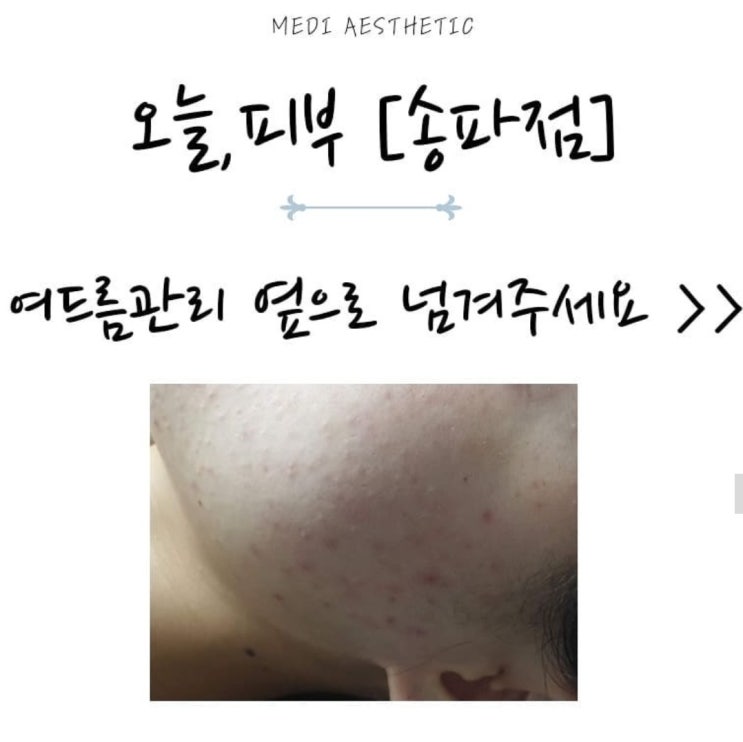  송파 좁쌀관리 피부일기5 오늘피부송파점
