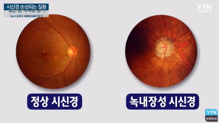  녹내장 증상 알아보기