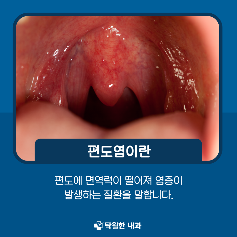편도선염 전염