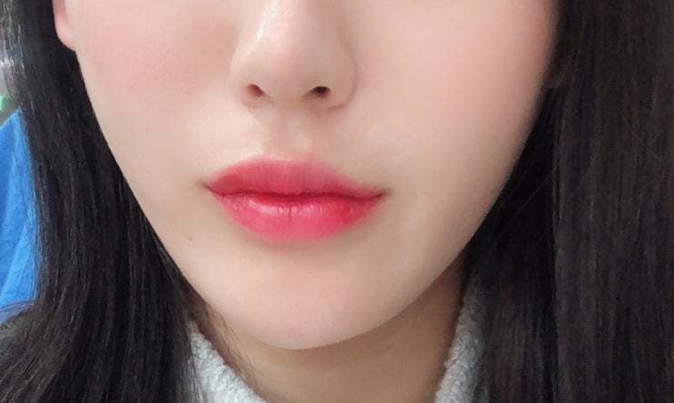  피부과 VVIP의 슈링크 리프팅 후기 (통증, 부작용)