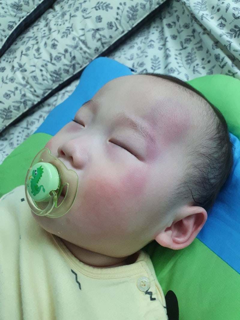 10개월 아기 넘어짐사고(멍크림후기) 10개월 아기 넘어짐사고(멍크림후기)