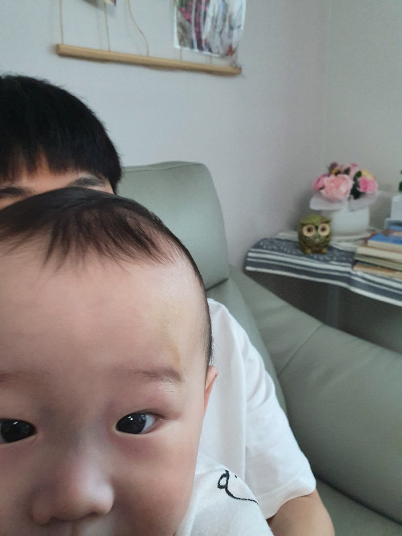 10개월 아기 넘어짐사고(멍크림후기) 4