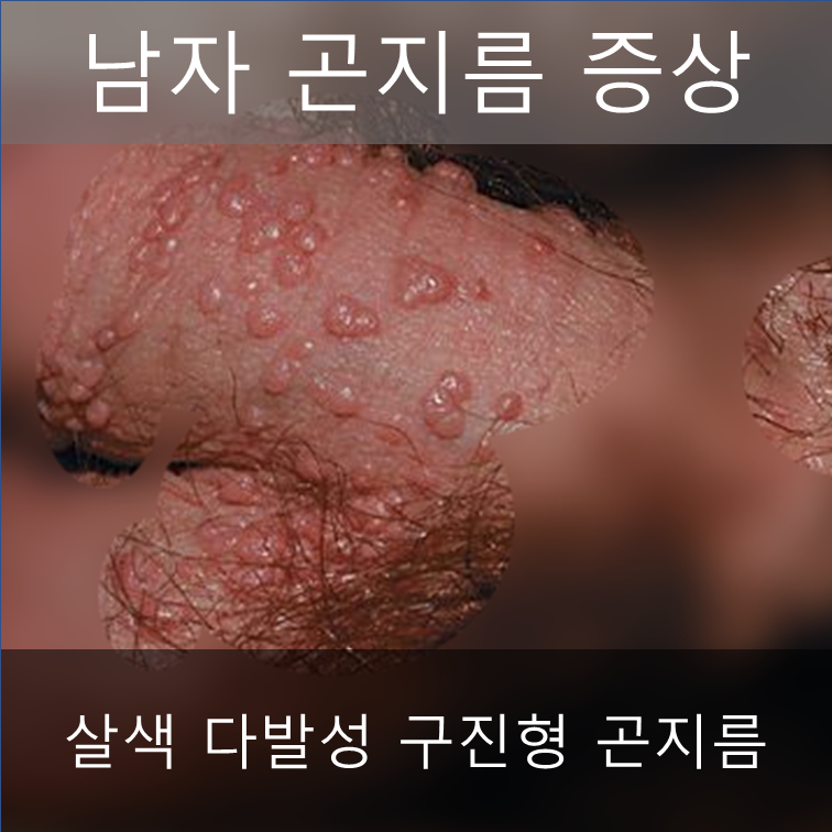 여성의 직경, 치료하지 않고 방치한 결과 ㅠ.ㅠ