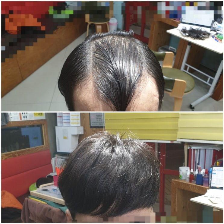  보톡스증모술 아직도 모르세요?