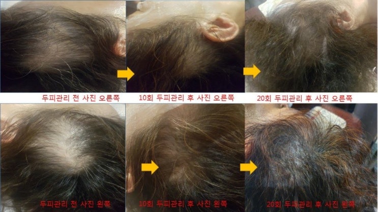  탈모 초반에 잡자!! MTS 톡스틱