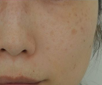 검버섯제거 비용이 너무 비싸다면 무조건 천연마스크 선택!