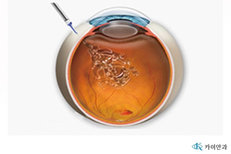 당뇨병 합병증 당뇨병성 망막증 당뇨병 망막증 증상 검사 치료 주사 레이저