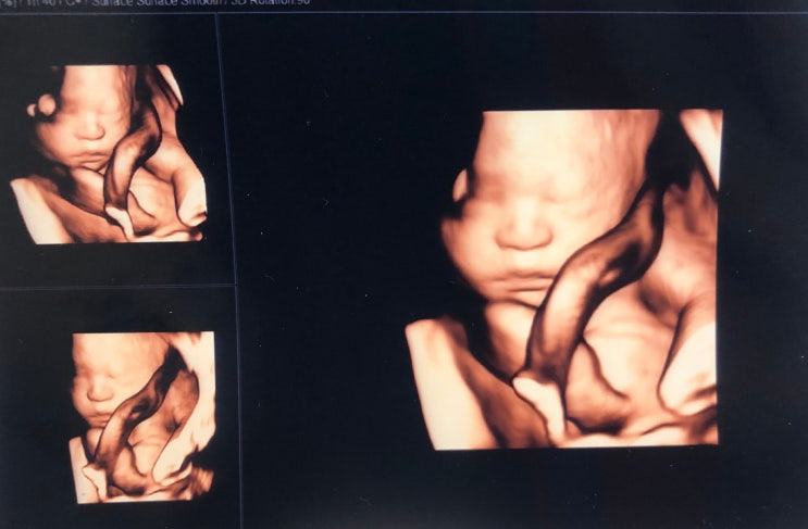 [임신28주/임신 8개월] 드디어 기다리던 입체초음파 보고 왔어요