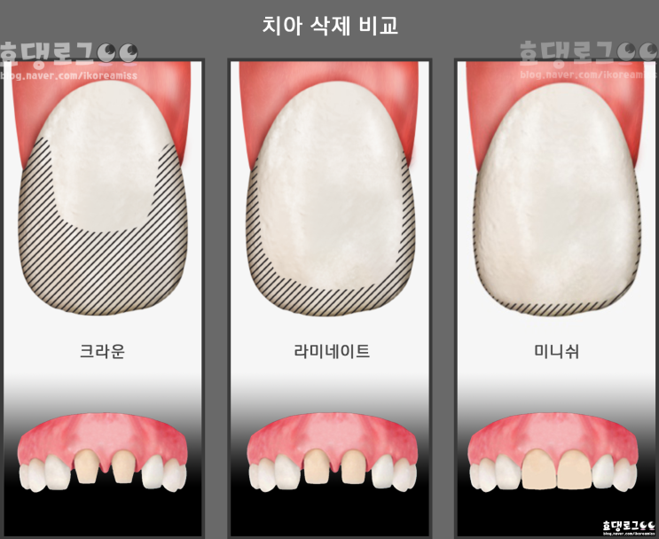'치아 삭제량'에 따른 치아성형 종류 미백+교정효과
