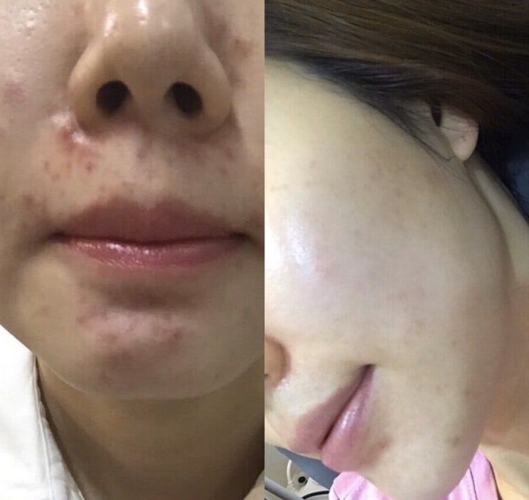  알라토너 + 알라앰플 + 아카라크림 / 마지막 핫딜 open