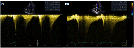 Apical HCM type : 네이버 블로그