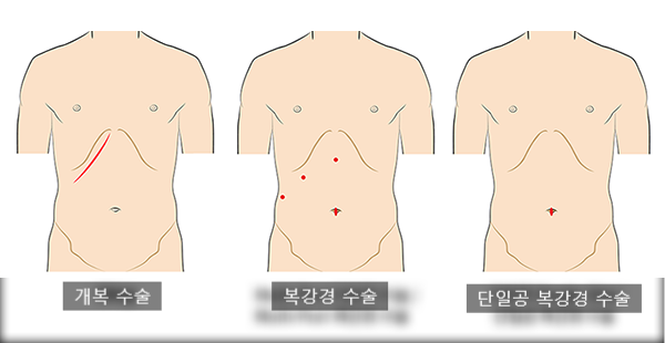 담석제거, 담낭 수술 비용 및 후기(Feat.단일통로 복강경) : 네이버 블로그