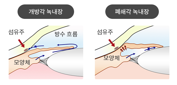 눈가의 통증이 갑자기 느끼면, 폐색 뿔 녹내장의 위험성이 있다