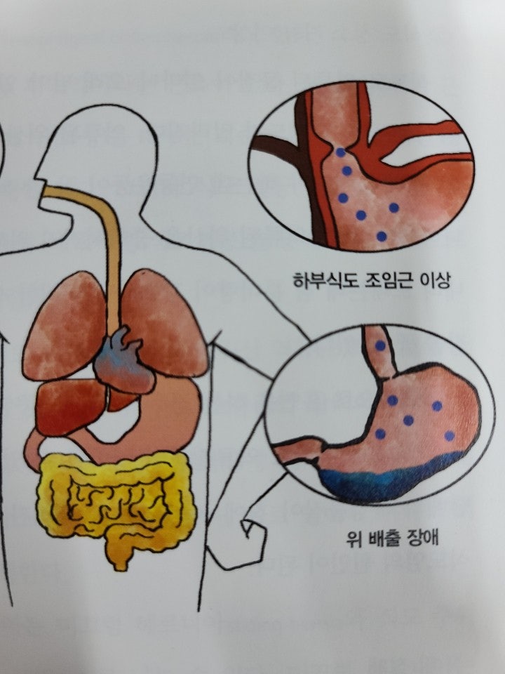인후통 증상과 역류성 식도염을 돕는 방법 9