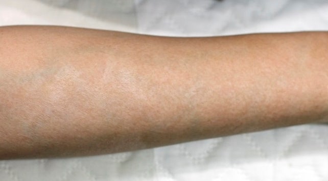 오래된 심재성 2도, 3도 화상 흉터 치료, 색소 침착 레이저 치료 사진 : 강서구 화곡 리뉴미 피부과 2