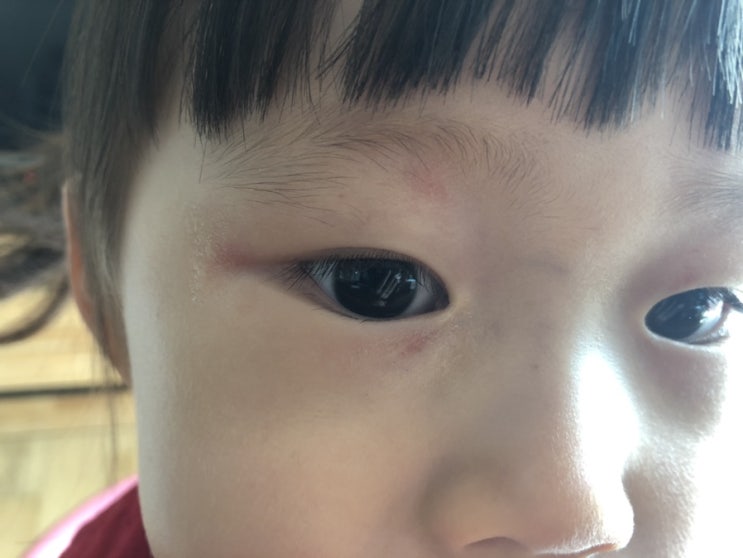  4살아이 눈주위 빨갛게 번져서 소아과 포러스안연고 처방
