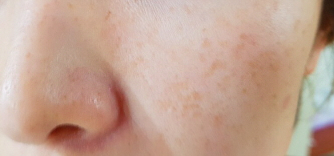 기미 치료 레이저 없이 홈케어로 피부관리 성공했습니다.