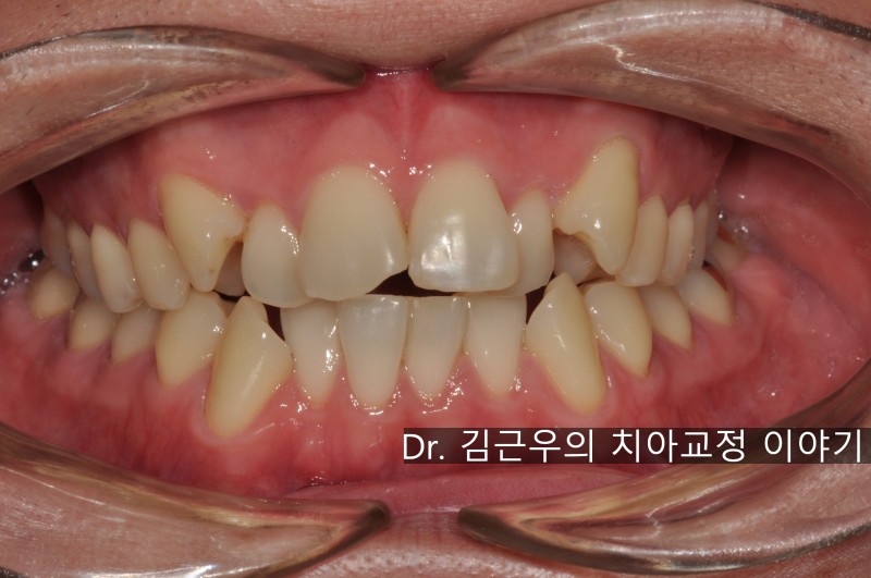치아 교정 발치 통증 : 네이버 블로그