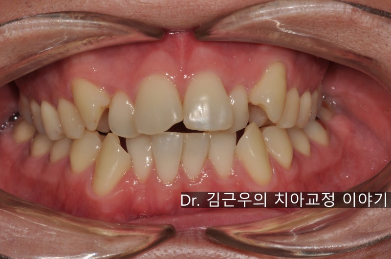 치아 교정 발치 통증 : 네이버 블로그 치아 교정 발치 통증 : 네이버 블로그