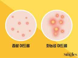  등드름 생활습관원인 간편케어 바디브러시 스크럽 바디크림 등드름 제거