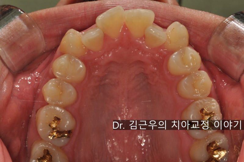 치아 교정 발치 통증 : 네이버 블로그 치아 교정 발치 통증 : 네이버 블로그