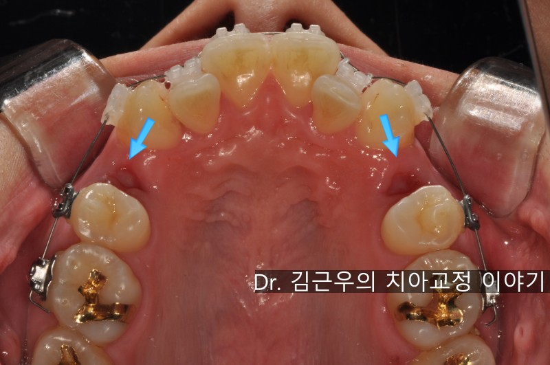 치아 교정 발치 통증 : 네이버 블로그