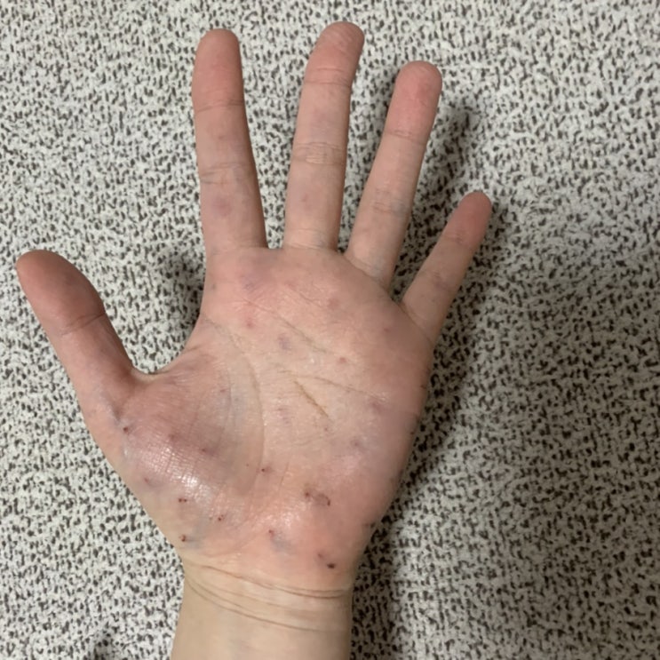  손다한증 다한증 보톡스 후기(세란통마취통증의학과의원)
