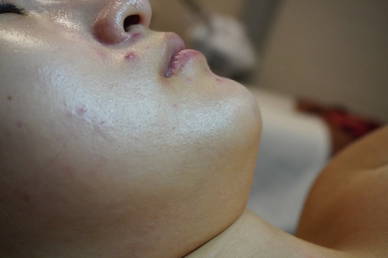 부산 피부관리샵 동래 윤앤윤에서 받아본 싸이블로 하이푸 리프팅 2