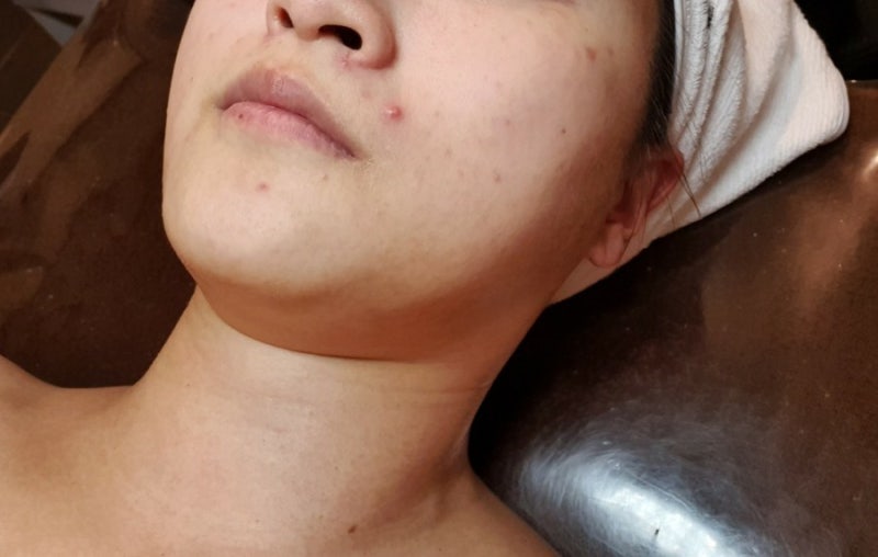 부산 피부관리샵 동래 윤앤윤에서 받아본 싸이블로 하이푸 리프팅 4