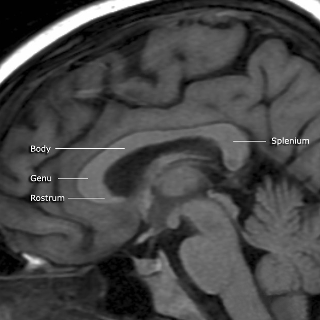 corpus callosum 뇌량 : 네이버 블로그