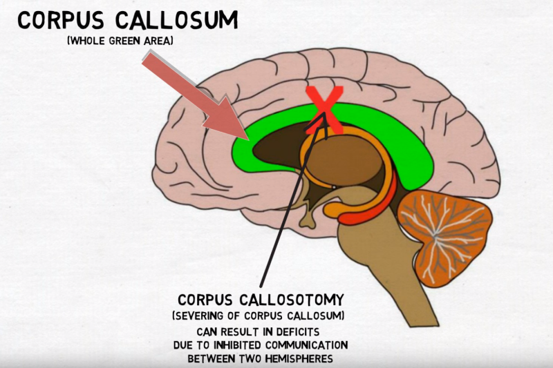 corpus callosum 뇌량 : 네이버 블로그