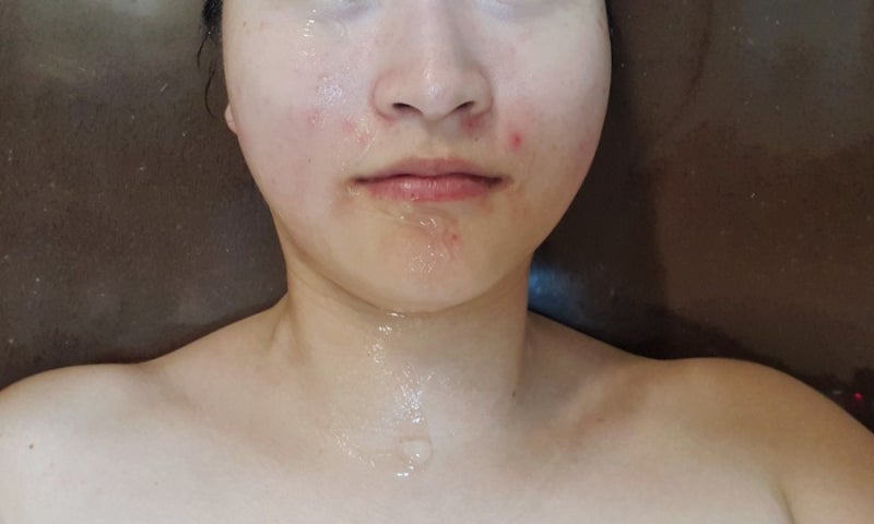 부산 피부관리샵 동래 윤앤윤에서 받아본 싸이블로 하이푸 리프팅