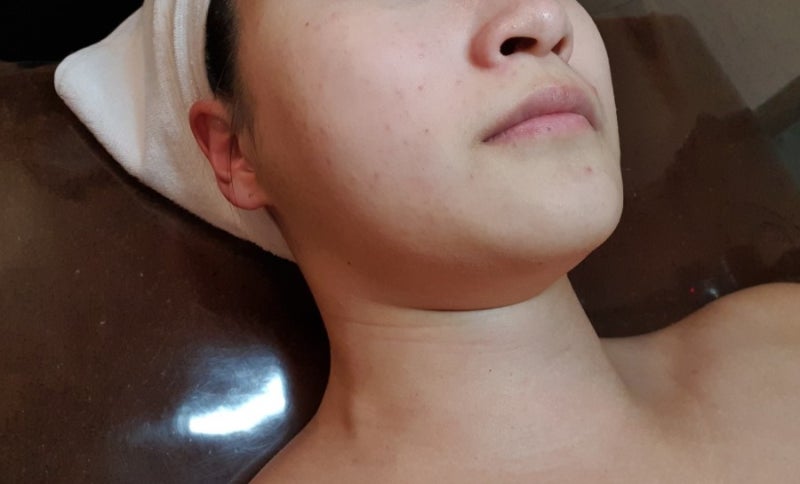 부산 피부관리샵 동래 윤앤윤에서 받아본 싸이블로 하이푸 리프팅 3