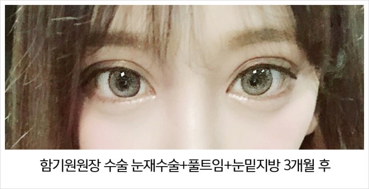  눈재수술 시원하게 고민 해결~