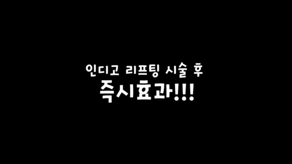  역삼피부과 인디고 초음파 리프팅 - V라인리프팅
