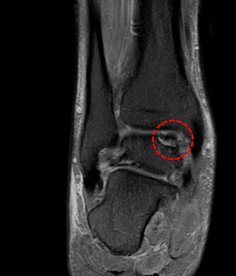 연골은 재생이 안 돼?! 잘 부러지고 상한 발목 연골에 BMAC 치료 인기! #SNU서울병원 족부전담팀