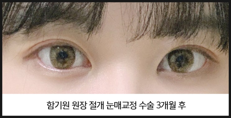  쌍꺼풀수술유명한병원 고민이 많기 때문에
