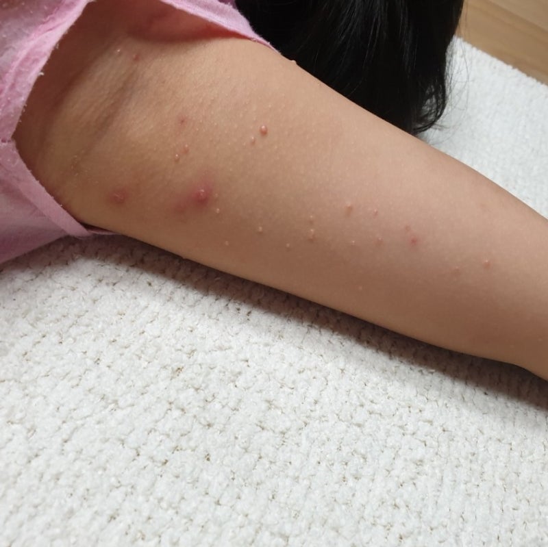 물사마귀없애는법(소아물사마귀제거)제가이런글을쓰는날이오다니요ㅠ