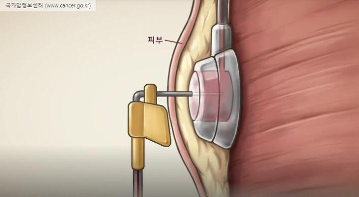 케모포트(팔뚝) 시술 그리고 첫 1차 항암치료