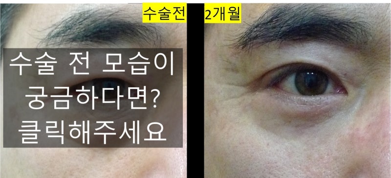50대 남자 상하안검수술 (무쌍상안검&하안검수술) : 네이버 블로그
