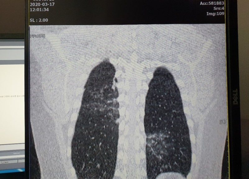 저선량 폐CT검사 폐렴초기진단과 폐암조기 검진 등 흉부질환 감별에 필수 : 네이버 블로그