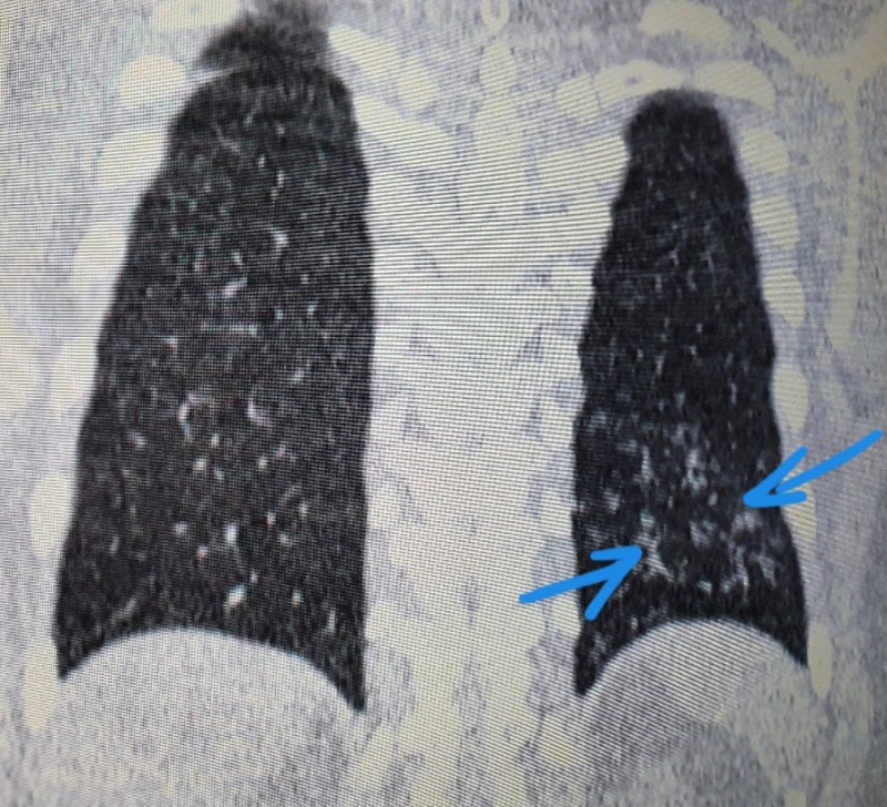 저선량 폐CT검사 폐렴초기진단과 폐암조기 검진 등 흉부질환 감별에 필수 : 네이버 블로그