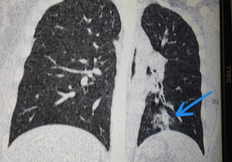 저선량 폐CT검사 폐렴초기진단과 폐암조기 검진 등 흉부질환 감별에 필수 : 네이버 블로그