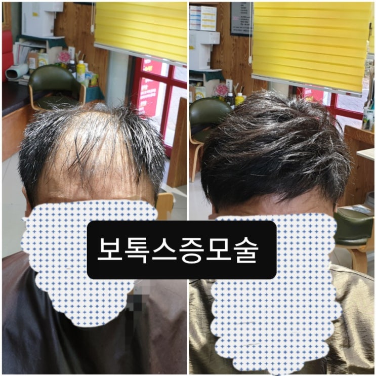  40대 남성 보톡스증모술 입니다~