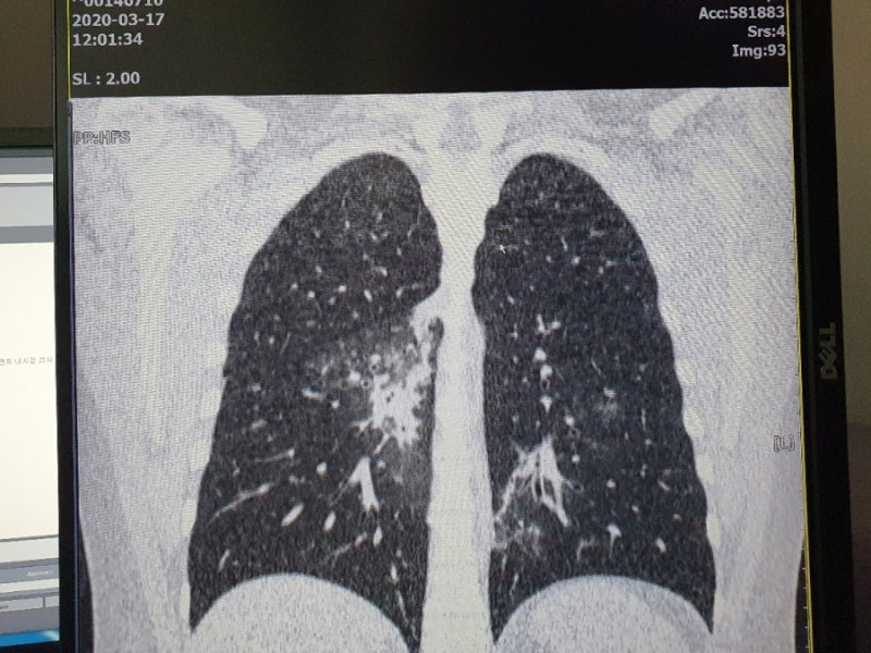 저선량 폐CT검사 폐렴초기진단과 폐암조기 검진 등 흉부질환 감별에 필수 : 네이버 블로그